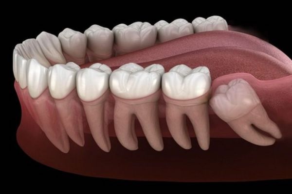 kieu-moc-lech-cua-rang-khon